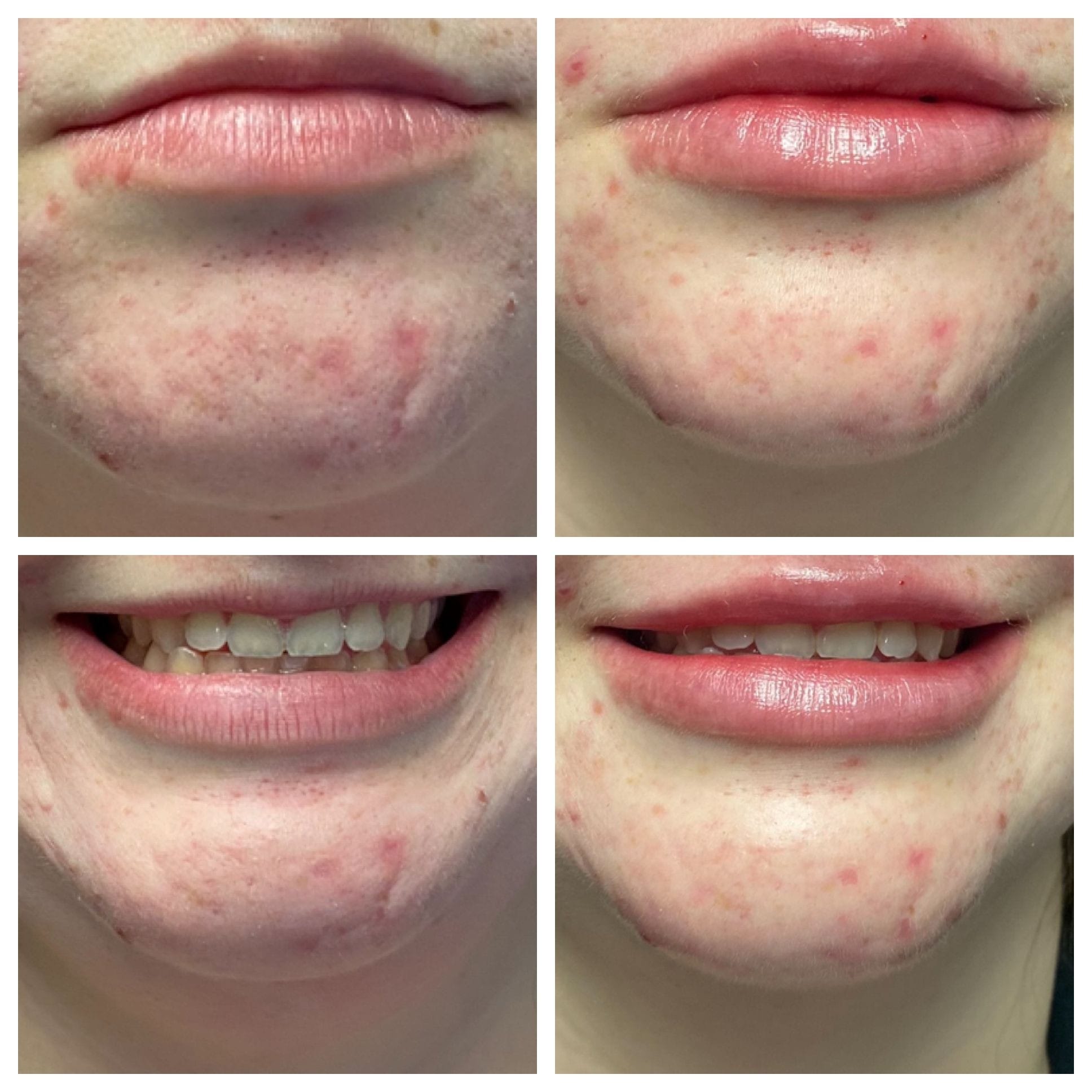 GLO Skin CareMD Lips-14